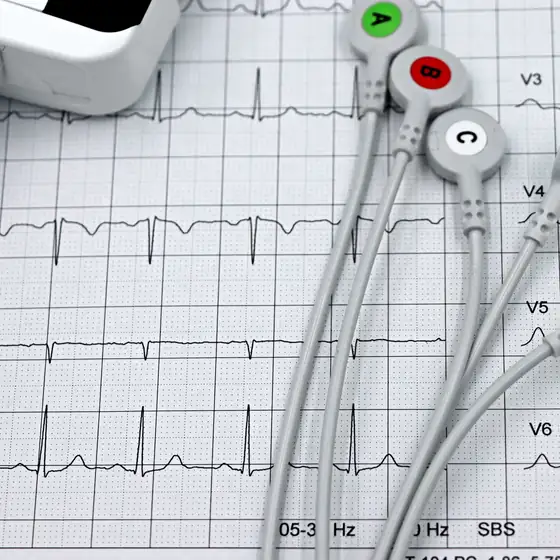 ECG leads lying on a printed cardiogram