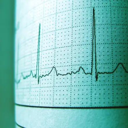 A close-up of an ECG printout